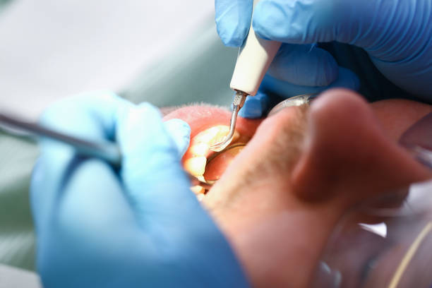 Best Emergency Dental Care for Broken or Chipped Teeth in Logan, IA
